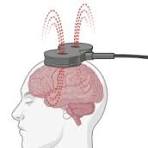 La Estimulación Magnética Transcraneal (EMT) y ACV